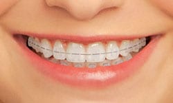 ceramic braces | Crane & Seager Orthodontics in Fort Collins and Loveland, CO