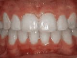 crowding of teeth after treatment | Crane & Seager Orthodontics in Fort Collins and Loveland, CO