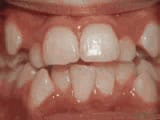 Crowding of teeth before treatment | Crane & Seager Orthodontics in Fort Collins and Loveland, CO