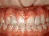 missing lateral incisors after treatment | Crane & Seager Orthodontics in Fort Collins and Loveland, CO
