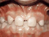 missing lateral incisors before treatment | Crane & Seager Orthodontics in Fort Collins and Loveland, CO