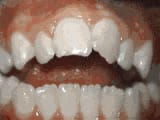 openbite before treatment | Crane & Seager Orthodontics in Fort Collins and Loveland, CO