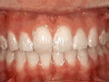 overbite after treatment | Crane & Seager Orthodontics in Fort Collins and Loveland, CO