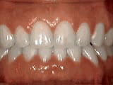 spacing of teeth after treatment | Crane & Seager Orthodontics in Fort Collins and Loveland, CO