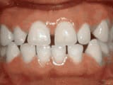 spacing of teeth before treatment | Crane & Seager Orthodontics in Fort Collins and Loveland, CO